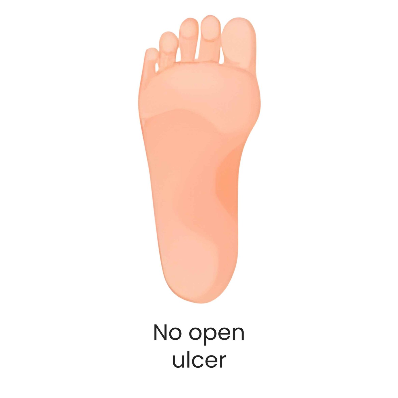 No open ulcer diabetic foot