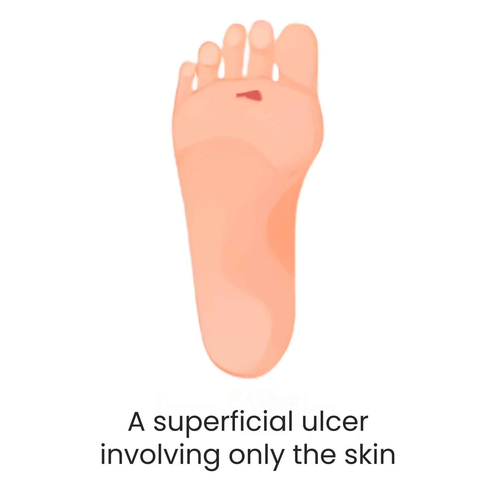 Superficial diabetic foot ulcer
