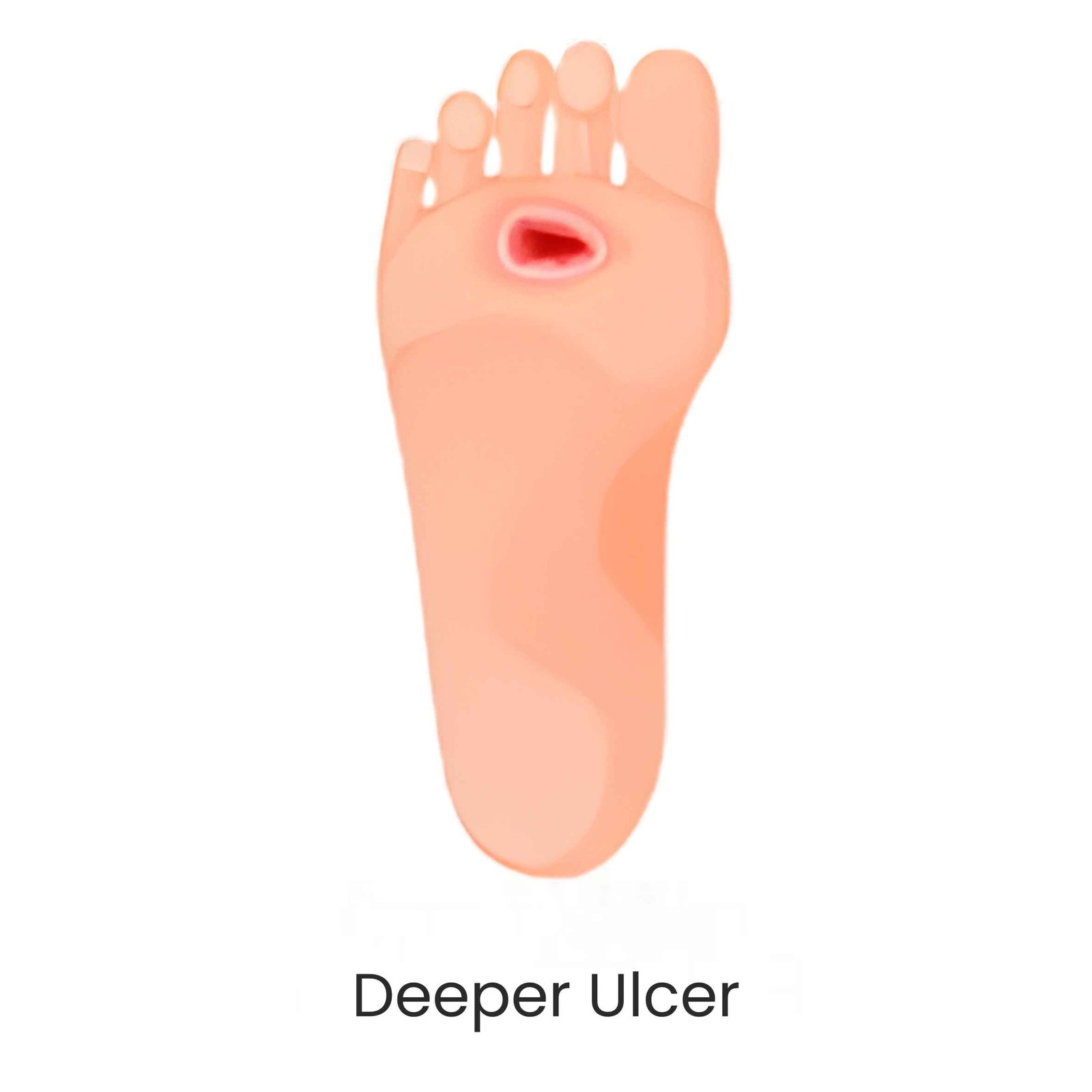 Deep diabetic foot ulcer
