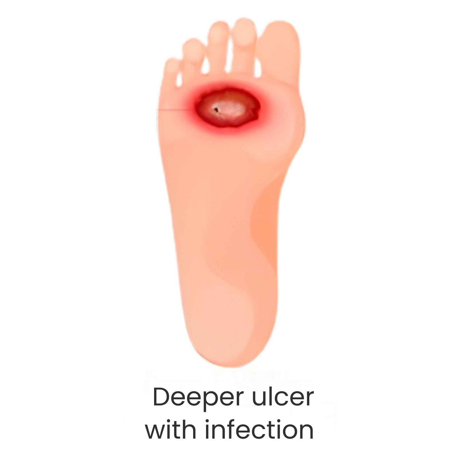 Deeper ulcer with infection diabetic foot