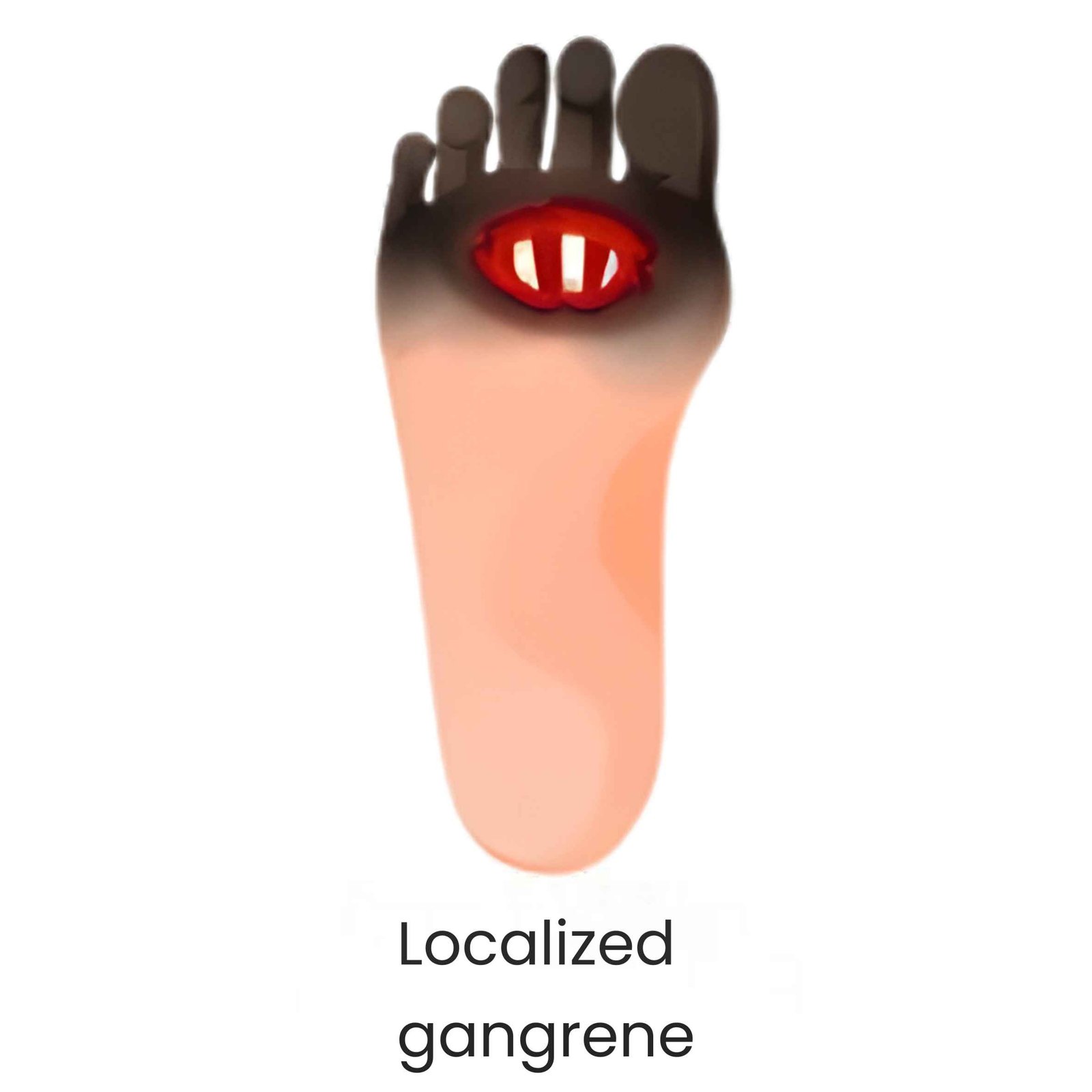 Localized gangrene diabetic foot